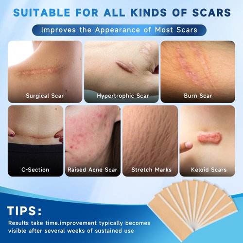 Rvlaim Silicone Scar Sheets, Silicone Scar Tape(5.7” x 1.57” 10 Pcs), Silicone Scar Sheets for Surgical Scars, Keloid Bump Removal, Stretch Marks Removal, C-Section, Burn et
