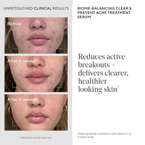 Regine Switzerland Acne Treatment Trial Kit - Salicylic & Mandelic Acid for Clear Skin - Travel Size for Acne-Prone Skin