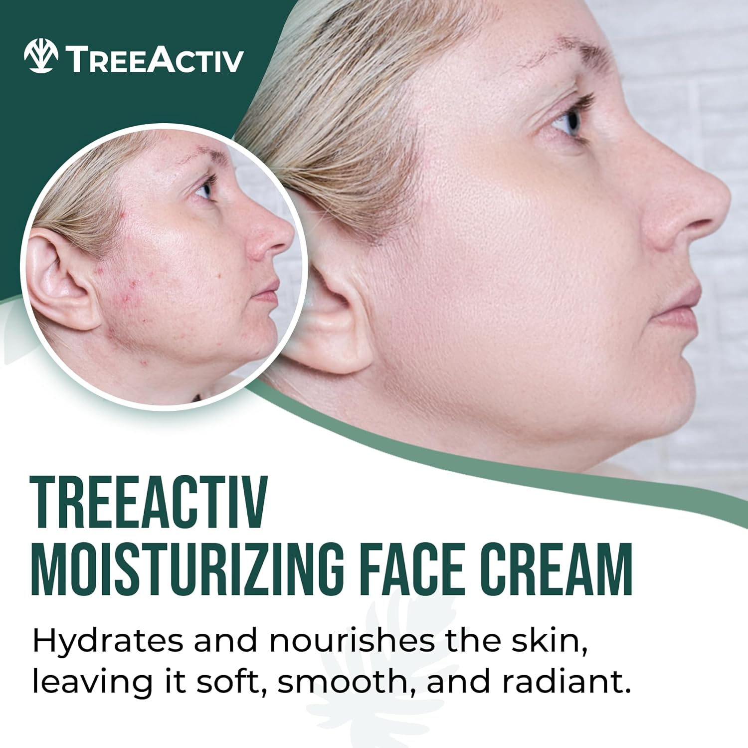 TreeActiv Acne Eliminating Face Cream - Moisturizing Tea Tree Formula for Balanced Skin | 2 fl oz