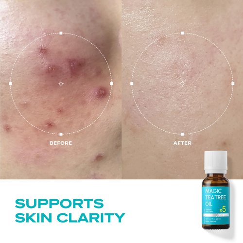 BLANC NATURE Magic Tea Tree Oil Spot Care for Face, Clarifying Facial Oil for Oily and Sensitive Skin, Lightweight and Fast Absorption, Vegan Korean Skincare, 0.68 fl oz (20ml)
