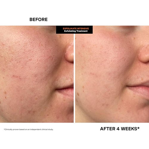 Kate Somerville ExfoliKate Intensive Exfoliating Treatment - Salicylic & Lactic Acid Facial Scrub & Mask, 0.5 Fl Oz