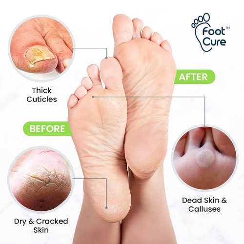 FOOT CURE Exfoliator & Callus Remover Pedicure Set – Care Kit Includes File for Dead Skin, Tea Tree Oil Soak Salts, Urea Cream 40 Percent Removal Gel Made in USA, Ivory, 4 Piece