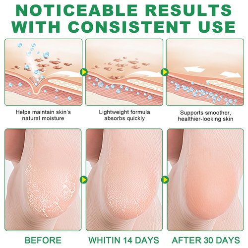 60% Urea Cream with 2% Salicylic Acid & Aloe vera Cracked Heel Stick, Long-lasting Moisture, Repair Cracked Heels, Deep Moisturizing Heel Balm with Aloe Vera, Coconut Oil, Tea Tree Oil, 1.41 oz / 2PCS