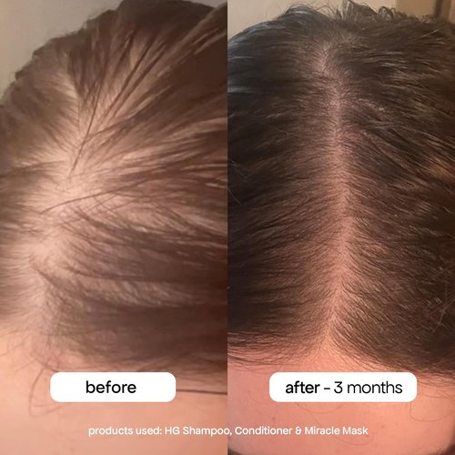 BondiBoost HG Anti-Thinning Shampoo & Conditioner Set - Clinically Tested for Fuller, Thicker Hair | 16.90 fl oz Each, Sulfate-Free Formula