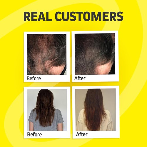 Foli Tonic Hair Growth Vitamins - DHT Blocker with Saw Palmetto & 10000mcg Biotin | 60 Vegan Capsules for Thicker, Fuller Hair
