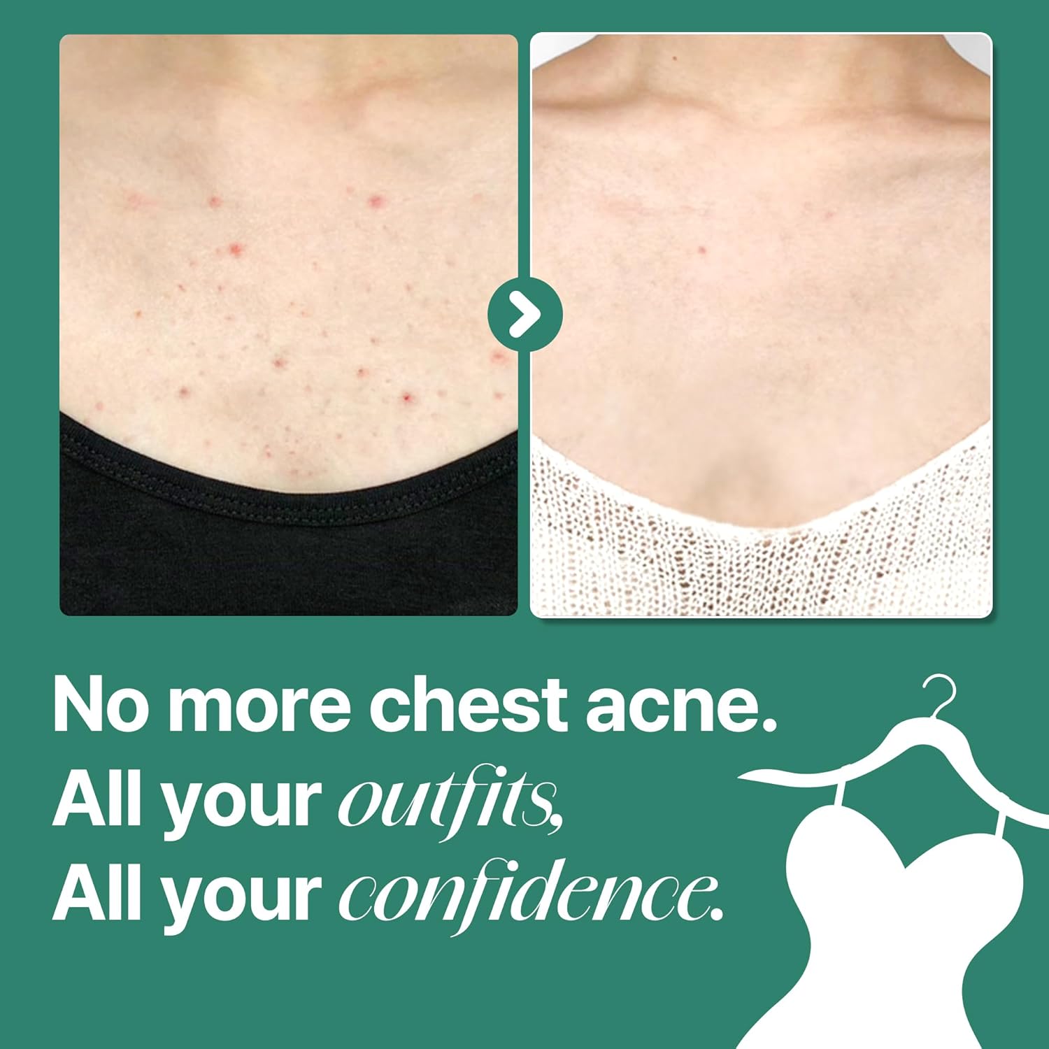 Some By Mi AHA BHA PHA Acne Clear Body Cleanser - Beta-Panthenol Repair Cream Bundle | 30 Days Supply