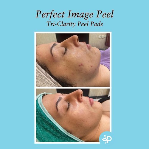 Tri-Clarity | Peel Pads with Salicylic Acid & Tea Tree Oil - 25% Strength for Clear Skin