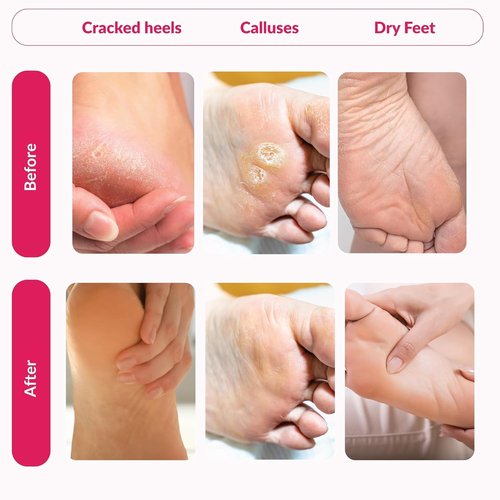Summer Foot Peeling Mask That Removes Dead Skin - Dermatologically Tested Callus Remover for Dry Cracked Feet - Exfoliating Foot Peel Mask for Baby Soft Feet - 2 Pack with Cucumber & Urea Extracts