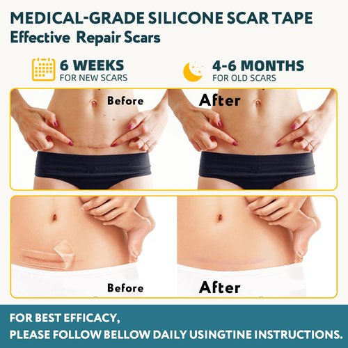 Silicone Scar Tape - 60" x 1.6" Roll - 1.5M, Scar Treatment for Improves Surgical, Keloid, Hypertrophic Scars - Medical Grade Reusable Silicone Scar Sheets