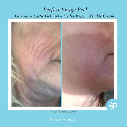 Glycolic Gel Peel - 10% Strength with Retinol & Green Tea Extract for Radiant Skin