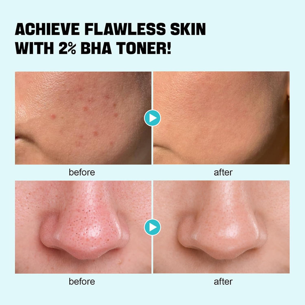 ZealSea Salicylic Acid Toner - Blackhead Remover & Pore Minimizer | Gentle Alcohol-Free BHA (6.76 oz)