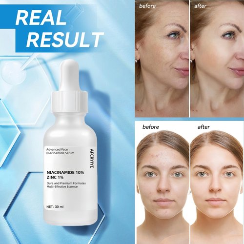 Niacinamide 10% + Zinc 1% Serum for Face – Oil Control, Acne, Pore Minimizer & Blemish Reduction – Lightweight, Non-Greasy Facial Serum, 30ml (1 Fl Oz) (1)