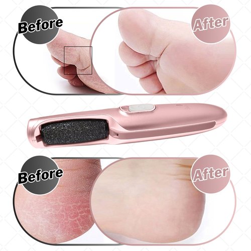 Powerful Electric Callus Remover Wand – Rechargeable Foot File, Grinder & Scrubber - Removes Dead, Hard Skin & Calluses – Best Pedicure Tool for Soft, Smooth Feet for Men & Women (Rose Gold)