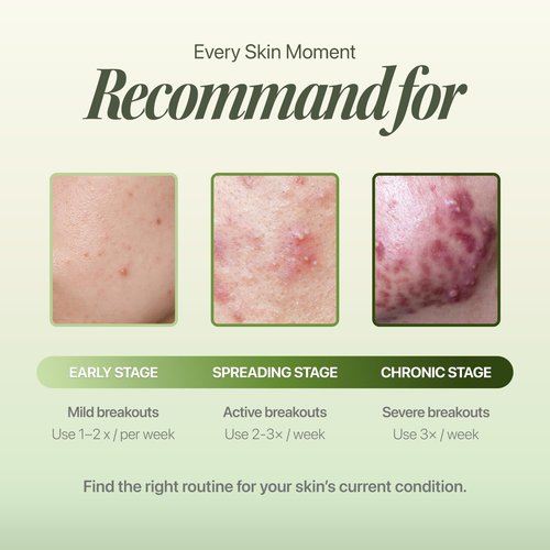 EIOM Trouble Patch Mask – Acne Face Mask & Full-Face Hydrocolloid Acne Mask for Acne-Prone Skin, Skin-Balancing Reset Care with Tea Tree Biome, Korean Face Mask (20ml x 4), Valentine’s Gift