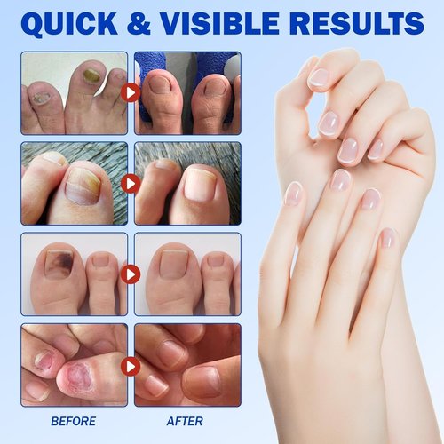 Nail Patches for Toenails & Fingernails – 63Pcs Parches para uñas con hongos, 8-Hour Fungus Nail Care Repair Stickers for Damaged Nails, for Extra Strengthening, Safe for Sensitive Skin