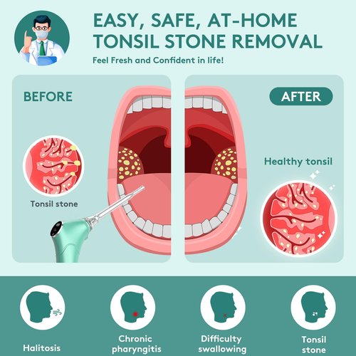 Alitake Electronic Vacuum Tonsil Stone Removal Kit - Tonsil Stone Remover with Built-in LED Light 3 Suction Mode - Fight Bad Breath Oral Irrigator 5X Magnifying Mirror for Stone Removal (Green)