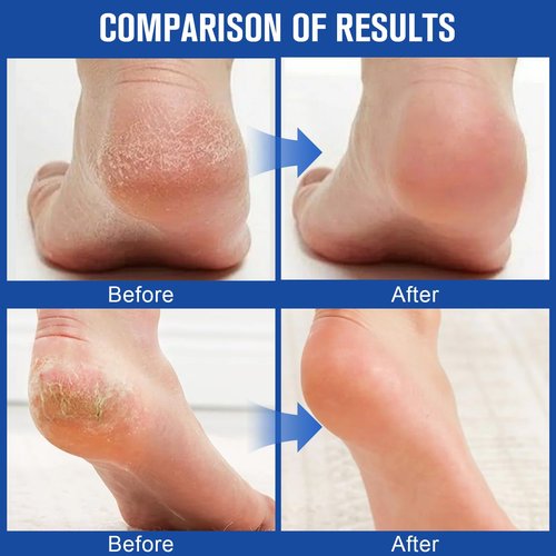 Holyarm 3PCS 60% Urea Hydrating and Anti-Cracking Foot Cream, Maximum Strength Urea Cream for Feet, Foot Lotion Stick for Heels, Dry Hands & Rough Knees, Smoothing Skin Women and Men