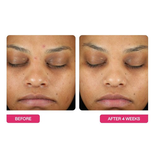 BeautyStat Triple Action Exfoliating Peel Pad - Gentle Daily Treatment for Uneven Tone, Fine Lines & Enlarged Pores