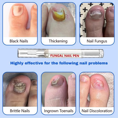 Fungal Nail Pen with Allicin & 25% Undecylenic Acid, Nail Repair Pen | Extra Strength Nail | Toenail & Fingernail Care 2pcs