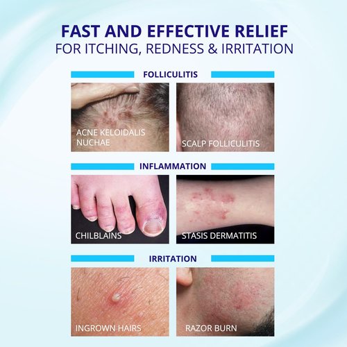 TAGRID Folliculitis Antifungal Treatment Set: Ultimate Duo for Ingrown Hair, Folliculitis Relief and Fungal Skin Care - Antibacterial Soap for Athletes & Active Lifestyles