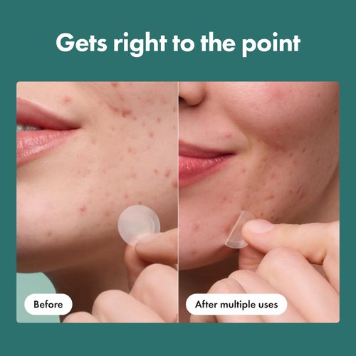 Mighty Patch Micropoint Large Hydrocolloid Pimple Patches for Face Blemishes from Hero Cosmetics, Acne Stickers for Early Stage Zits & Hidden Pimples, 395 Proprietary Micropoints, 8 Count