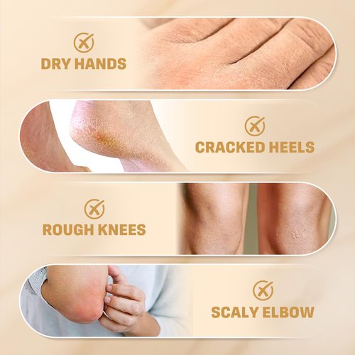 Clyecfra 60% Urea Cream with 2% Salicylic Acid, Urea Cream 60 Percent for Feet & Hands- Maximum Strength Moisturizer for Rough, Dry, Thick & Cracked Skin, Callus Remover, Deep Hydration, 150g