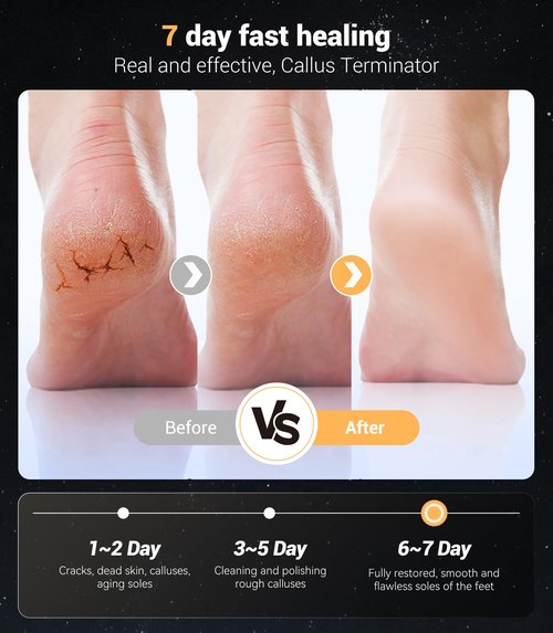 5-in-1 Professional Electric Callus Remover(Portable & Foldable), Removes 99.92% of Calluses in 3 Mins, Rechargeable Foot File Pedicure Kits with 10 & 40 Grit Pads for Soft Smooth Feet, Purple