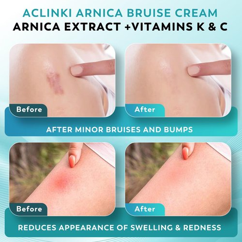 ACLINKI Arnica Bruise Cream for Bruising & Swelling Relief – Arnica Montana with Vitamins K, C & E – Lightweight Non-Greasy Cream for Sensitive & Thin Skin, Face & Body,Fragrance Free, 4.2 oz