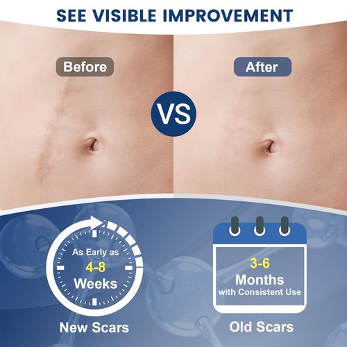 Rvlaim 100% Silicone Scar Gel Scar Cream, Advanced Silicone Gel for Removal of Surgical, Burns, Acne Scar, Old and Recent Scars and Stretch Marks, 1.7 oz/50ml