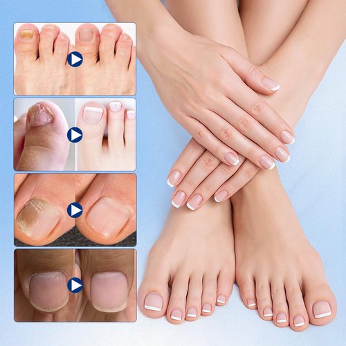 Toenail Fungus Treatment Extra Strength - 42 Pcs Fungal Nail Patches, nail repair patches-8-Hour Firm Adhesion, Nail Repair patches for Damaged Nails, Overnight Renewal for Men and Women