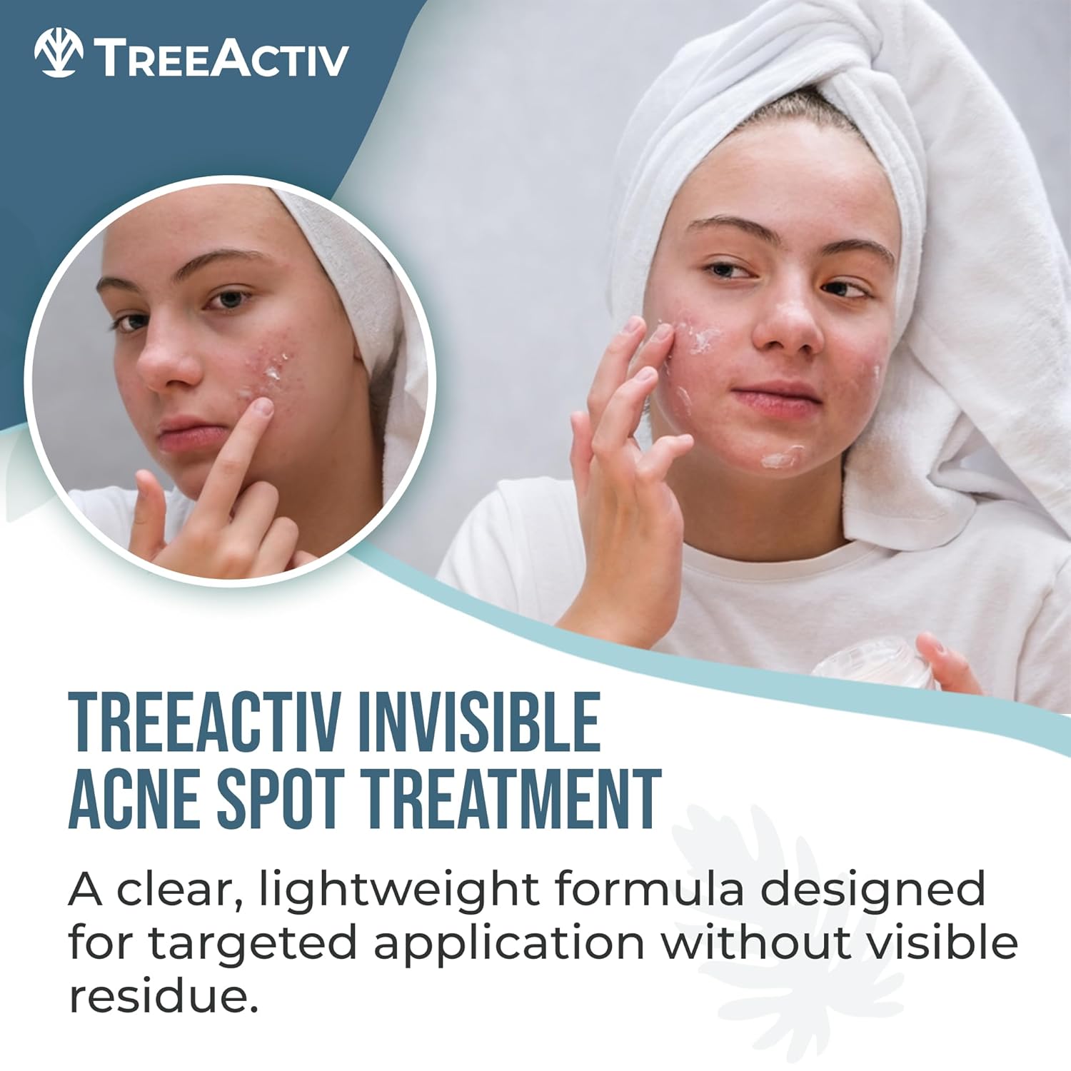 TreeActiv Acne Spot Cream - Clear-Drying Formula with Salicylic Acid & Tea Tree Oil | 150+ Uses for Acne-Prone Skin