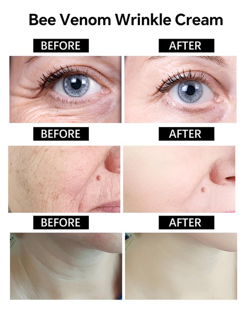 BotoxCream – BotoxBee Venom Wrinkle Removal Cream Anti-Aging, Firming, Lifting, and Moisturizing Skin Cream for All Skin Types – Recovery and Anti-Wrinkle Care (Bee)