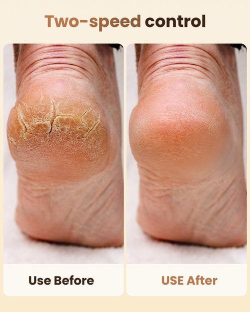 Electric Callus Remover for Feet - 2-Speed Rechargeable Pedicure Kit with 3 Rollers, IPX4 Waterproof Foot Scrubber & Digital Display | Professional Dead Skin & Callus Remover for Women/Men