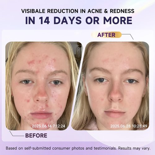 Cystic Acne Treatment for Face – Hormonal Acne Spot Treatment Pimple Cream with Azelaic Acid | Redness Reducing Acne Moisturizer for Rosacea & Sensitive, Acne-Prone Skin | Teens & Adults, 1.7 oz