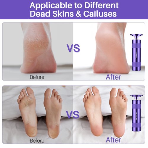 Electric Foot Callus Remover, 2-in-1 Electric Foot Filer/Nail Filer, Callus Remover for Feet with 60Pcs+12Pcs Sandpaper Discs，Holiday Gift Foot Repair Tool, Purple