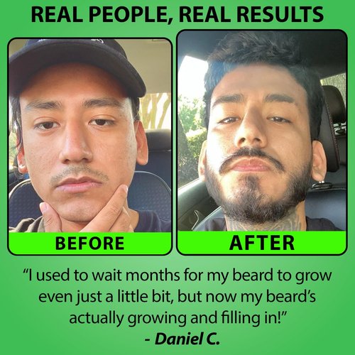 Minoxidil for Beard Growth – 5% Serum with 2X Biotin & Rice Water, Promotes Thicker, Fuller Facial Hair, Ideal for Patchy Areas, Revitalizes Follicles