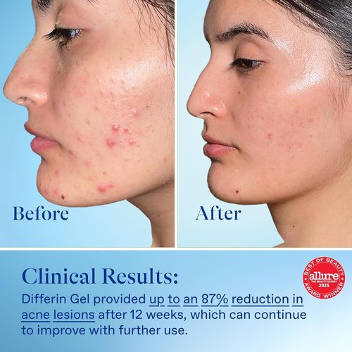 Differin Acne Treatment Gel - 0.1% Adapalene Retinoid for Acne-Prone Skin | 45g Pump, 90-Day Supply