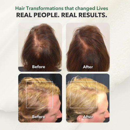 HairSmart Hair Growth Shampoo – Organic Shampoo with Ginger, Amla & Neem for Thicker, Healthier Hair (Shampoo.)