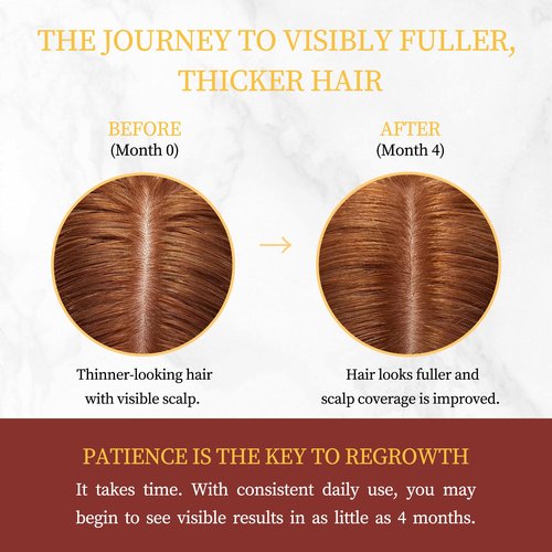 Minoxidil for Women Hair Growth with Biotin, Extra Strength Topical Minoxidil Serum Solution with Rosemary for Hair Regrowth Treatments, Non-Greasy, Helps Prevent Hair Thinning & Hair Loss