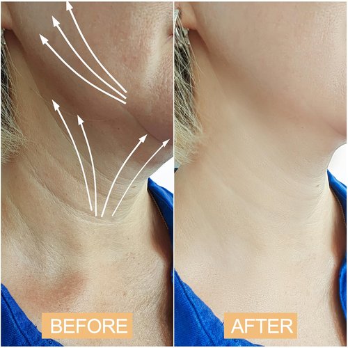 Snifflink Invisible Neck Lift Tape for Women - Instant Neck Tape Lifting Invisible for Turkey Neck & Double Chin - Waterproof Neck Tightening and Lifting Strips for Sagging Skin (Clear, 20 Pcs)
