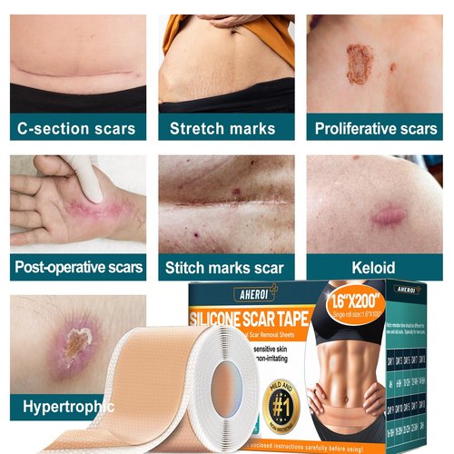 Aheroi Silicone Scar Tape, 1.6"x200" Silicone Scar Sheets(2 Rolls-5M)Medical Grade Scar Sheets for Surgical Scars, Soft Scar Patches Reusable Scar Removal Strips,Effective C-Section Keloid Tummy Treat