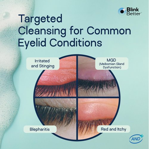 BlinkBetter BetterLids Foaming Eyelid Cleanser – Gentle Daily Foam for Eyelids, Eyelashe Wash & Face, Soothing Tea Tree Oil Formula with Ectoin & Centella, Non-Stinging, Preservative-Free, 2 fl oz