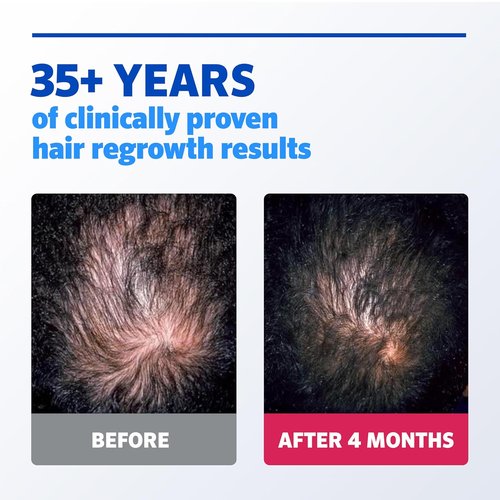 Regine Switzerland Men’s Rogaine Extra Strength 5% Minoxidil - Clinically Proven Hair Regrowth Solution | 3 Month Supply