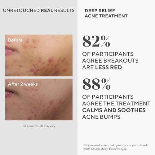 Murad Acne Treatment Combo - Deep Relief Treatment & Clarifying Cleanser with Salicylic Acid | Set of 2
