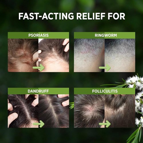 RoyceDerm Tea Tree Scalp Relief Spray - Comfort, Hydration & Balance - Conditioning Support for All Hair Types