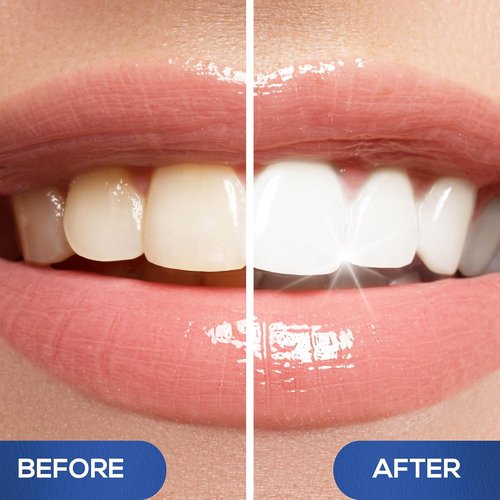 Venus Visage Teeth Whitening Pen - Award-Winning Formula for Low Sensitivity - 20+ Uses, Mint (2 Pack)