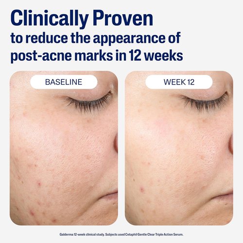 CETAPHIL Gentle Clear Post-Acne Serum - Oil-Free Retinol Alternative with Bakuchiol, 1 Fl Oz | Improves Skin Tone & Reduces Marks