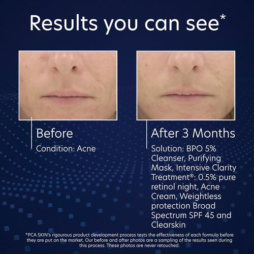 PCA SKIN 5% Benzoyl Peroxide Face Wash - Foaming Acne Cleanser for Oily Skin | 7 Oz Bottle