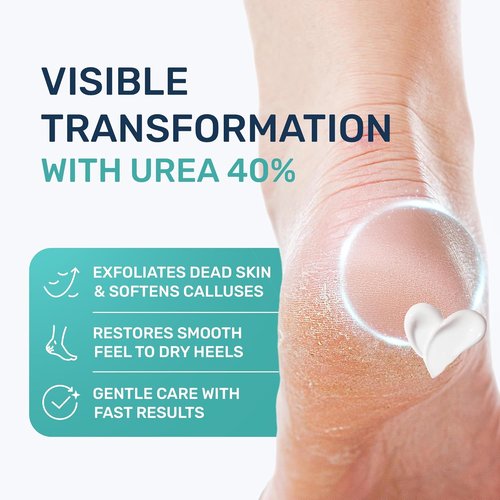 Urea Cream 40% - Maximum Strength Callus Remover Foot Cream for Dry Cracked Heels | 4.3 oz