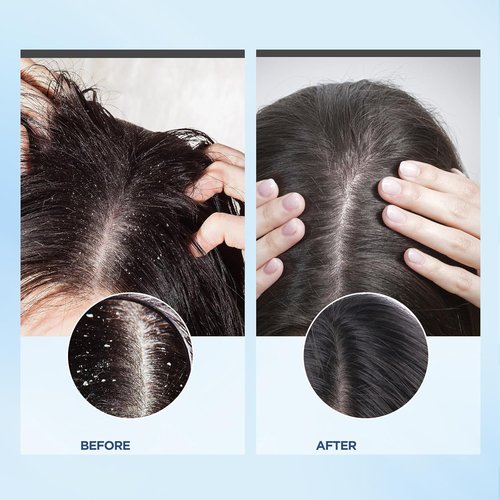Bablabear Scalp Exfoliator Scrub - Itchy Scalp Treatment for Dandruff Relief | Sulfate-Free, Clarifying Formula